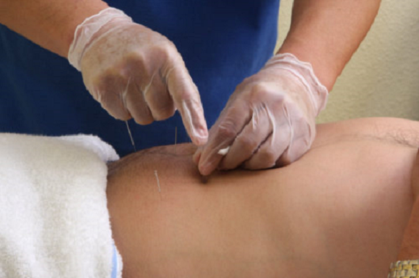 Dry Needling: What It Is, How It Works & Who It Helps