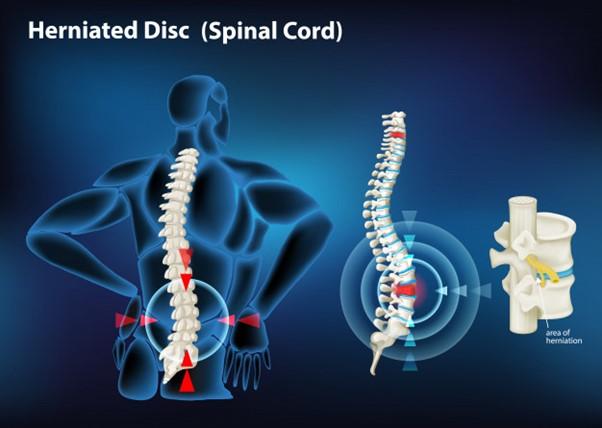 Sciatica: Symptoms, Causes & Treatment