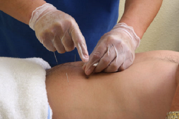 Dry Needling Therapy